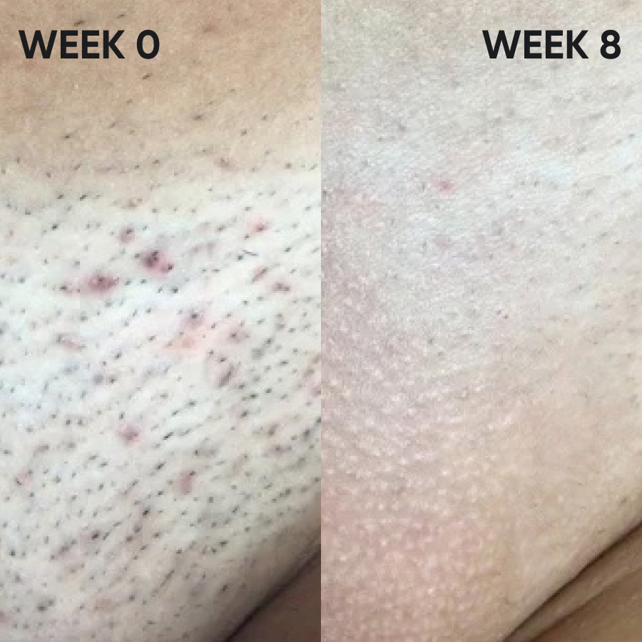 The Viral Tangible™ 2.0 IPL Laser Hair Removal Device